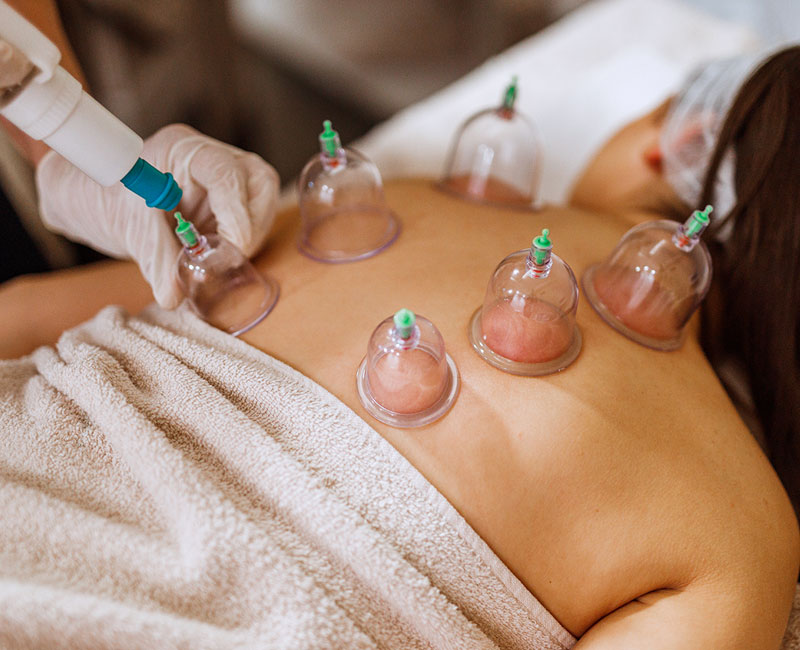 Cupping therapy treatment