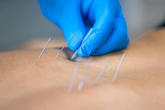Dry needling therapy